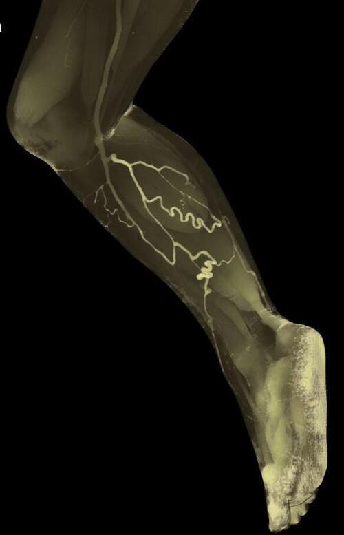 静脈瘤CT画像.jpg